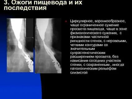 Стриктура пищевода
