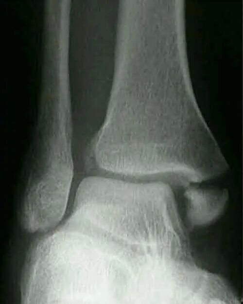 Fracture c