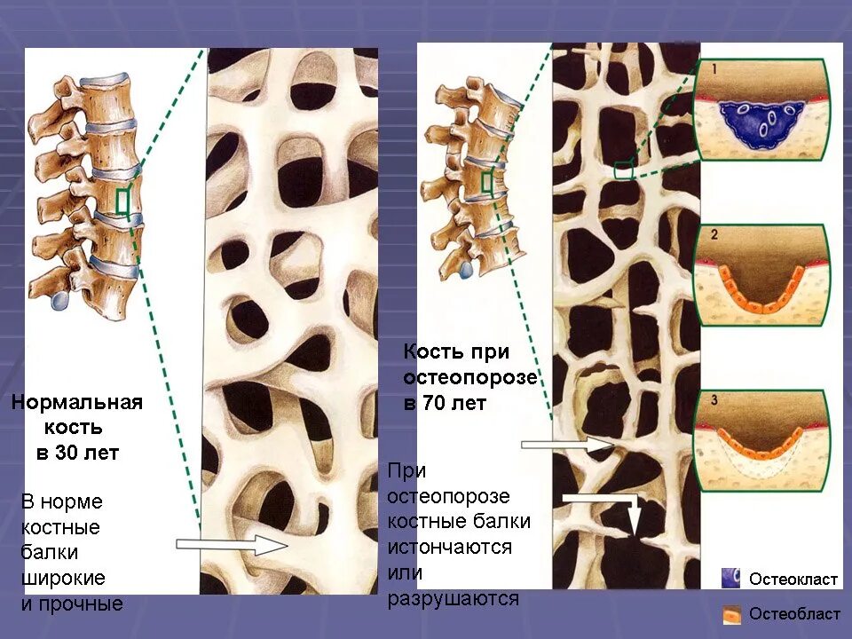 Признаком возрастных изменений костей является. Изменение костной ткани. Возрастные изменения костной ткани. Остеопороз кости. Кость при остеопорозе.