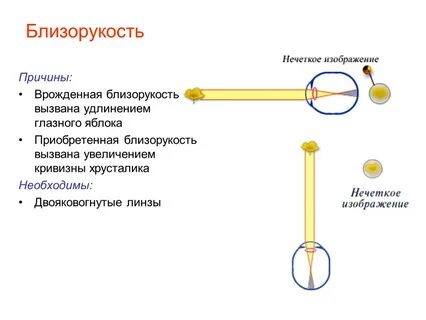 Перечислите причины врожденной приобретенной близорукости и дальнозоркости