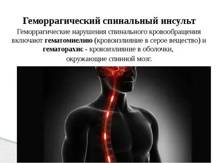 Инсульт позвоночника