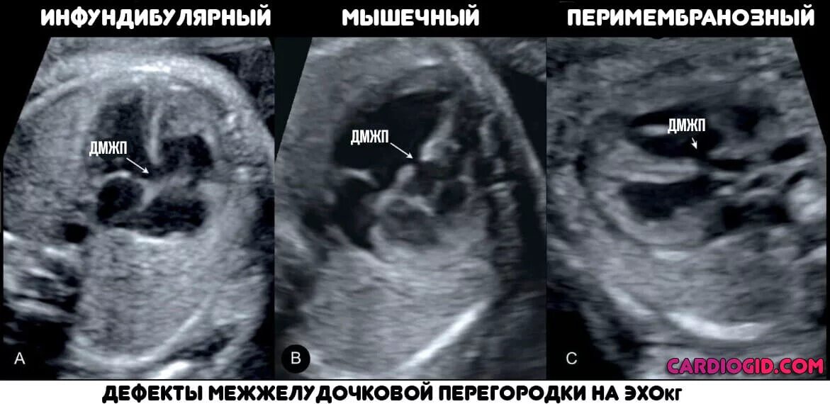 Мышечный дефект. Перимембранозные дмжп. инфундибулярный дефект межжелудочковой перегородки. дмжп у новорожденного эхокардиография. перимембранозный дмжп на эхокг.