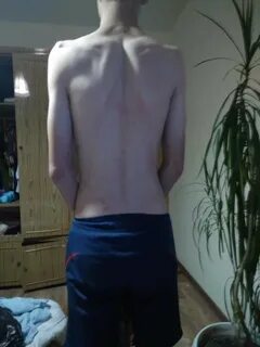 Сколиоз 15