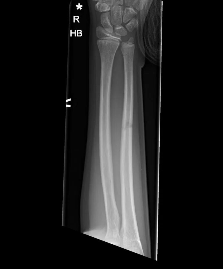 Radius fracture. Radius and ulna green stick fracture. radial shaft fracture p/ x-rey.