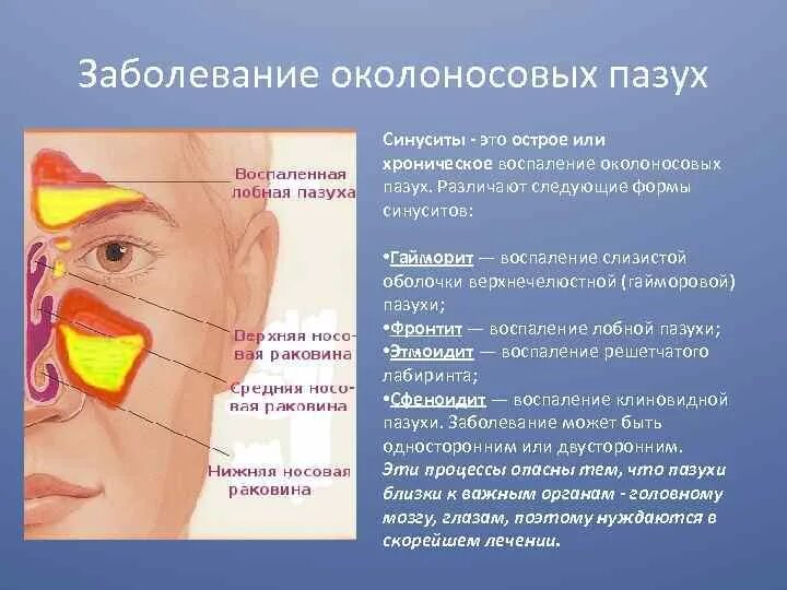 Болит переносица при нажатии насморка. Болезнь носовой синусит. Воспалительные заболевания носовой полости. Симптомы воспаления верхнечелюстной гайморовой пазухи. Риносинусит острый риносинусит.