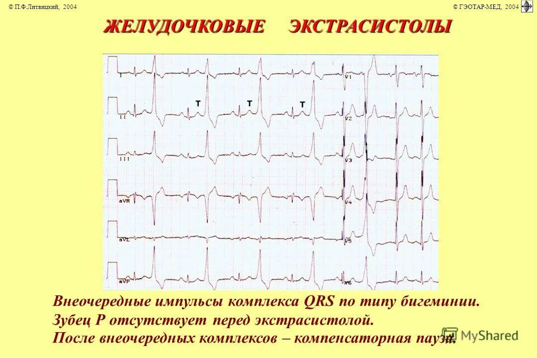 Типы желудочковых экстрасистол