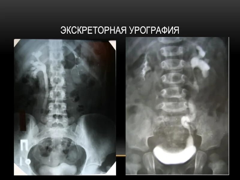 Как делается урография. Экскреторная урография норма. экскреторная урография патология. экскреторная урография нефроптоз. нефрофаза экскреторная урография.