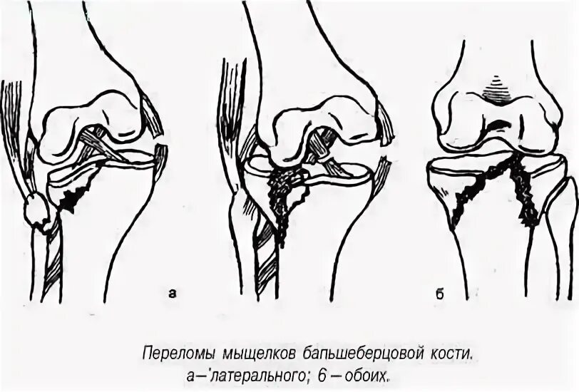 Лечение мыщелка