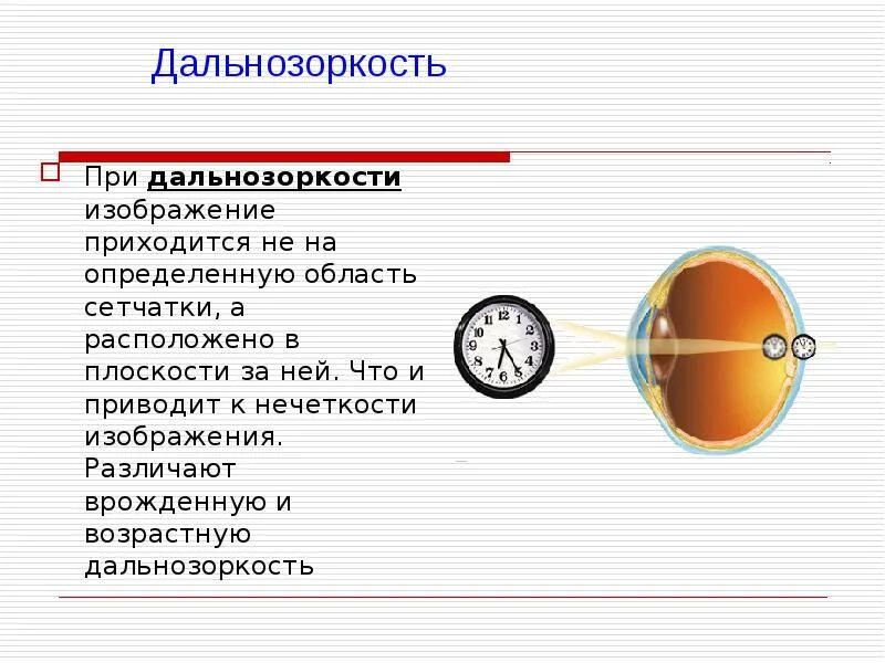 Почему возникает дальнозоркость. Дальнозоркость. дальнозоркость (гиперметропия). дальнозоркость развивается при. дальнозоркость презентация.