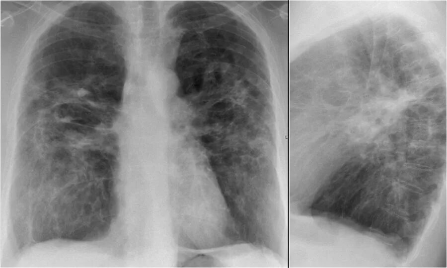 Фиброз обеих легких. Идиопатический пневмофиброз. Пневмофиброз легких рентген. Что такое плевропульмональный фиброз. Интерстициальный пневмофиброз.