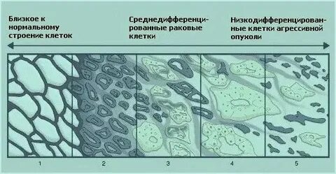Глиссона при раке предстательной железы