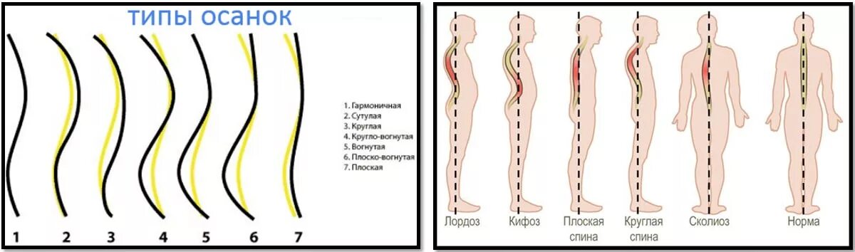 Нарушение изгиба позвоночника. Виды искривления позвоночника. Типы сколиоза позвоночника. Правильный изгиб позвоночника. Правильная осанка позвоночника.