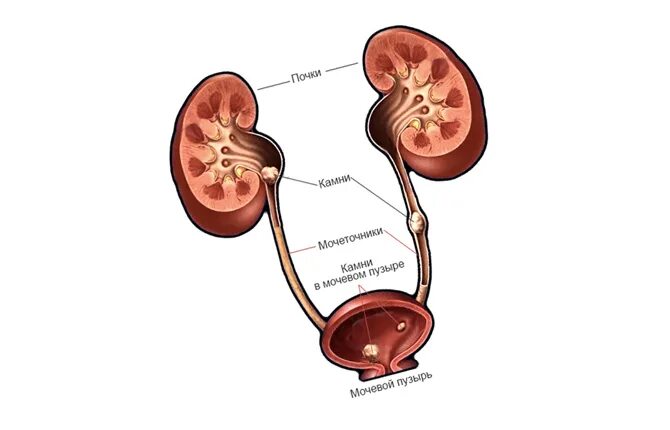 Камни в почках заболевание. Мочекаменная болезнь этиология. Камни в почках этиология. Мочекаменная болезнь. Этиология, патогенез, диагностика. Мочекаменная болезнь почек этиология.