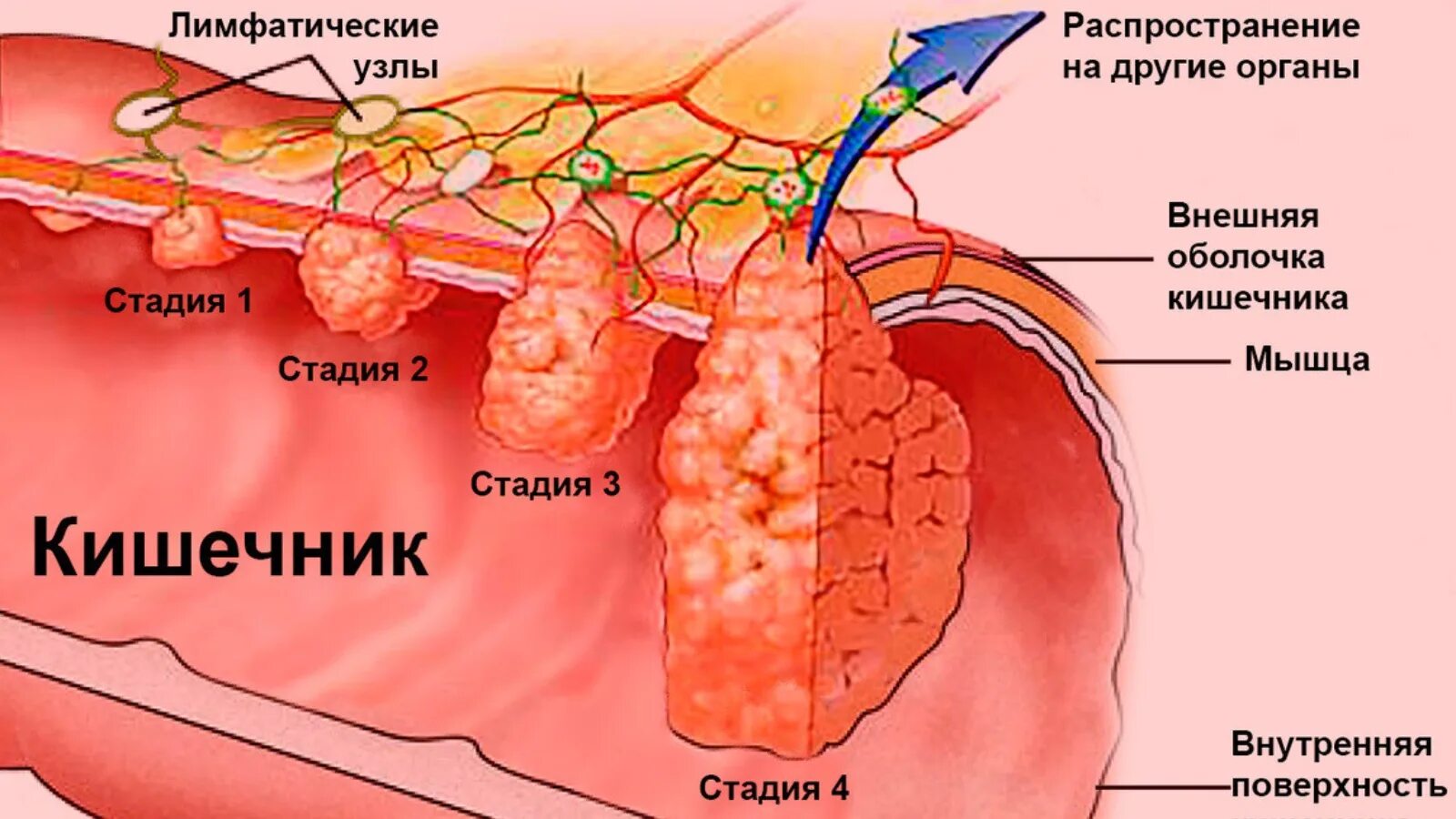 Колоректальный рак. Что важно знать
