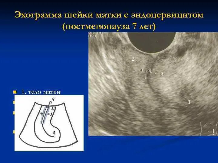 Хронический эндоцервицит на УЗИ. УЗИ признаки эндоцервицита. Шейка матки эндоцервит. Экзоцервицит и эндоцервицит