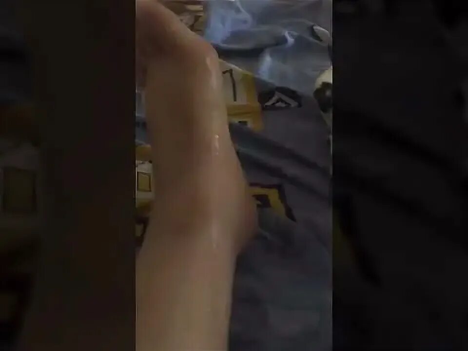 Рано снял гипс. Рано снял гипс