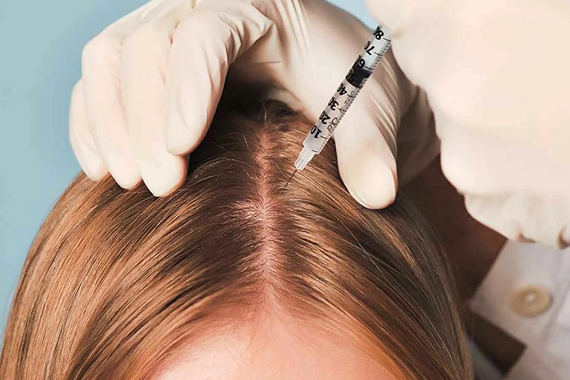 Prp плазмотерапия для волос. Мезо для волос. Мезотерапия головы. Prp плазмотерапия для волос. Плазмотерапия волосистой части головы.