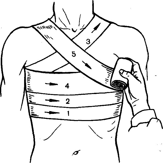 Спиральная повязка алгоритм. Наложение крестообразной повязки на грудную клетку. Крестообразная повязка на грудную клетку алгоритм. Крестообразная повязка на грудную клетку показания. Техника наложения повязок при ранениях грудной клетки.
