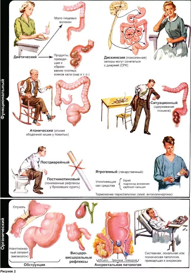 Толстая кишка запор. Атонический запор. Спастический запор.
