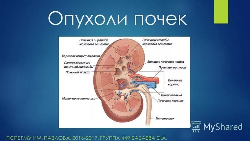 Опухоль почек у женщин. Опухоли почек презентация. Новообразование левой почки.