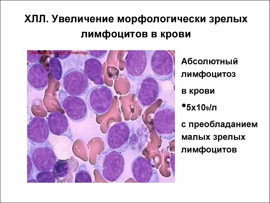 В -лимфоциты хронический лимфолейкоз. Хронический лимфолейкоз гистология. Хронический лимфолейкоз морфология. Лимфоциты гистология строение. Больным лимфолейкозом