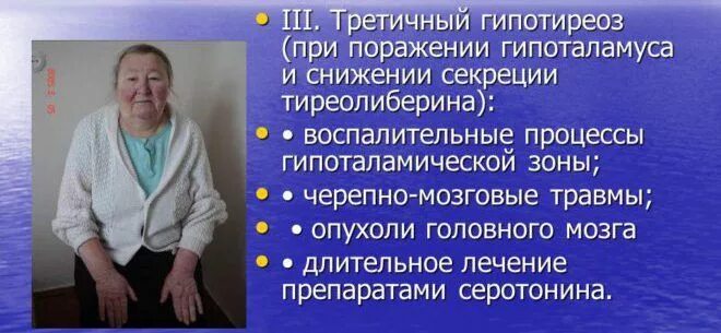 Гипотиреоз б. Третичный гипотиреоз. Третичный гипотиреоз симптомы. Ятрогенный гипотиреоз. Причины вторичного гипотиреоза.