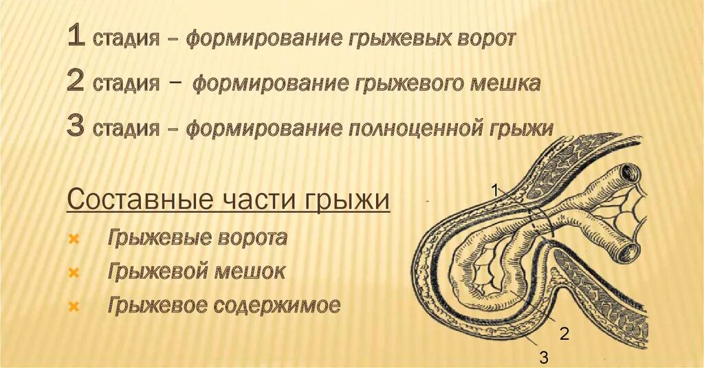 Может ли быть грыжа