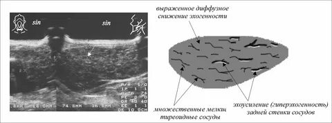 Структура поджелудочной диффузно неоднородная эхогенность повышена