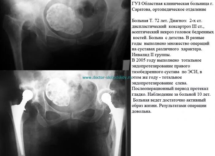 При коксартрозе дают инвалидность
