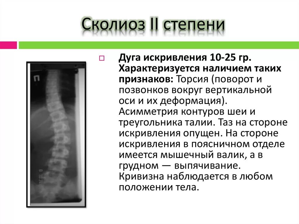 Сколиоз позвоночника 3 степени рентген. Рентген позвоночника сколиоз 2 степени. Сколиоз 2 степени рентген. Сколиоз 2 степени это