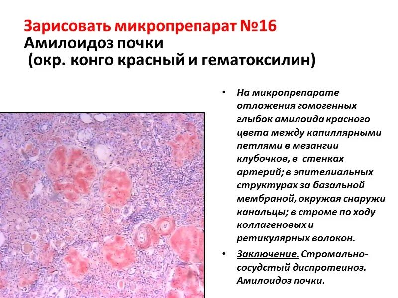 Амилоидоз почки микропрепарат Конго красный. Амилоидоз печени патанатомия. Амилоидоз почек патанатомия. Амилоидоз почки микропрепарат.