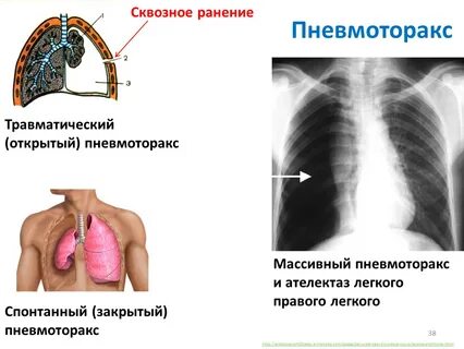 Понятие пневмоторакса