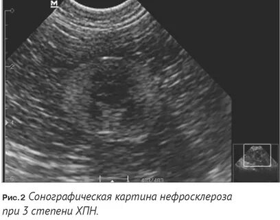 Сморщенная почка на узи