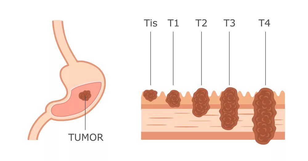 Стадии развития опухоли желудка. Онкология 3 степени желудка. Раковая опухоль желудка. Стадии карциномы желудка. Онкология желудка 4 стадия
