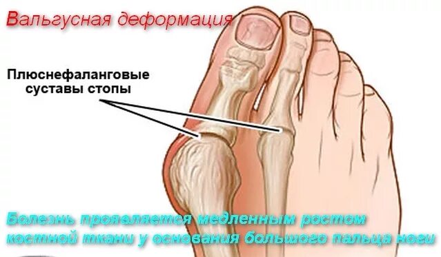 Причины болят пальцы на ногах почему. Болит большой палец на ноге. Воспаление сустава большого пальца.