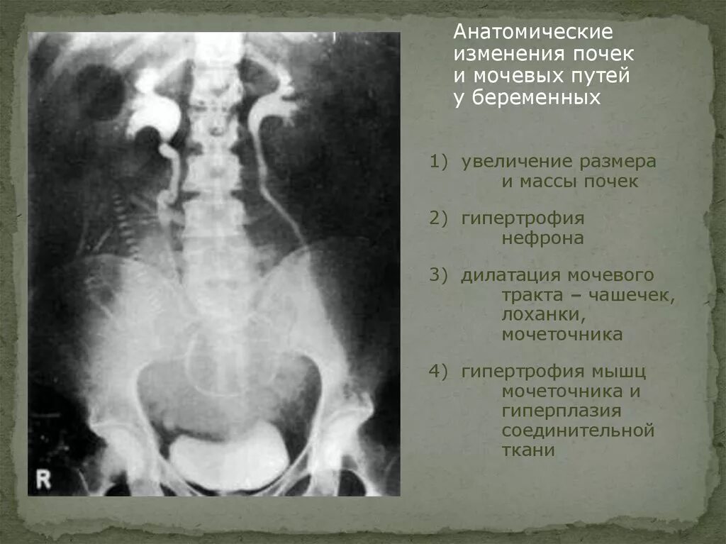 Изменение левой почки. Гиперплазия правой почки. Викарная гипертрофия почки.