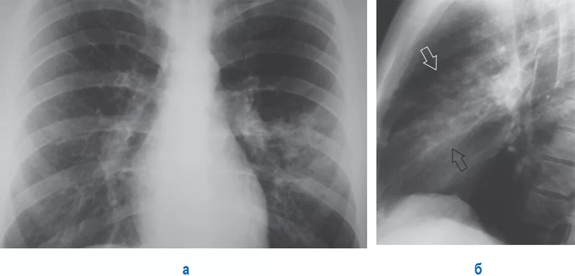 госпитальная пневмония рентген.