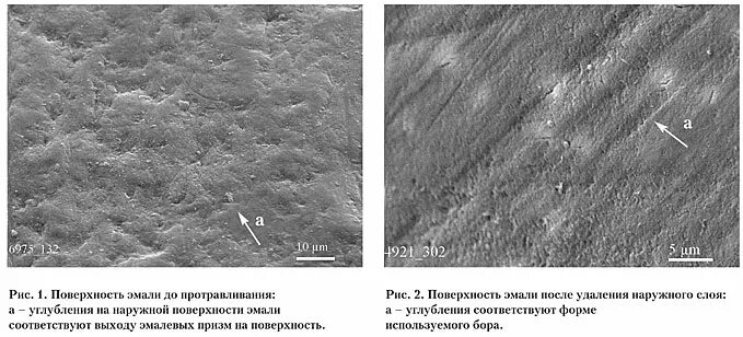 поверхностный слой эмали. поверхность эмали. поверхность эмали. перикиматы. зубная эмаль под микроскопом.
