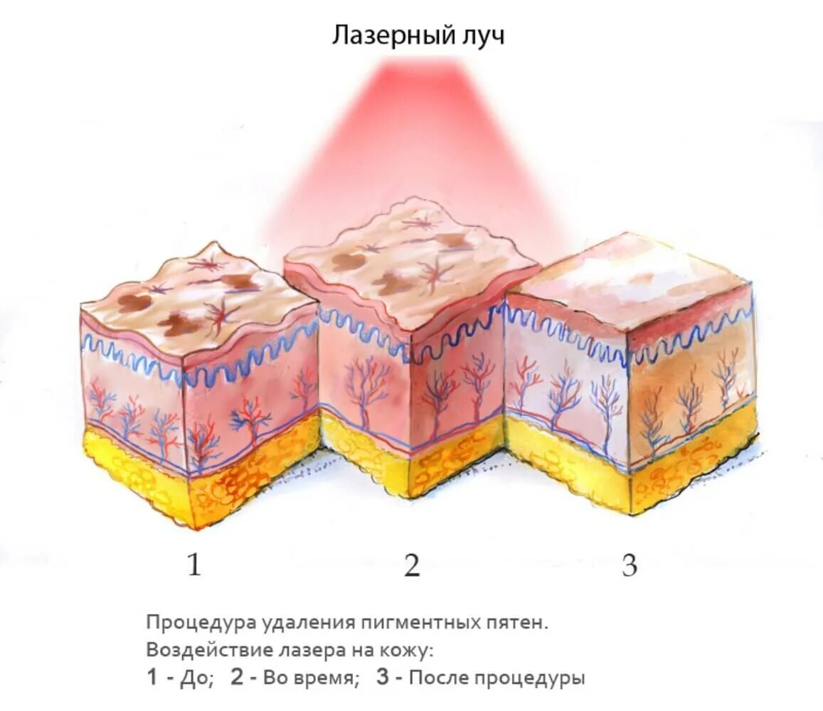 Пигмент кожи меланин находится. Воздействие лазера на пигмент. Воздействие лазера на кожу. Воздействие лазерного излучения на кожу. Пигментация кожи схема.