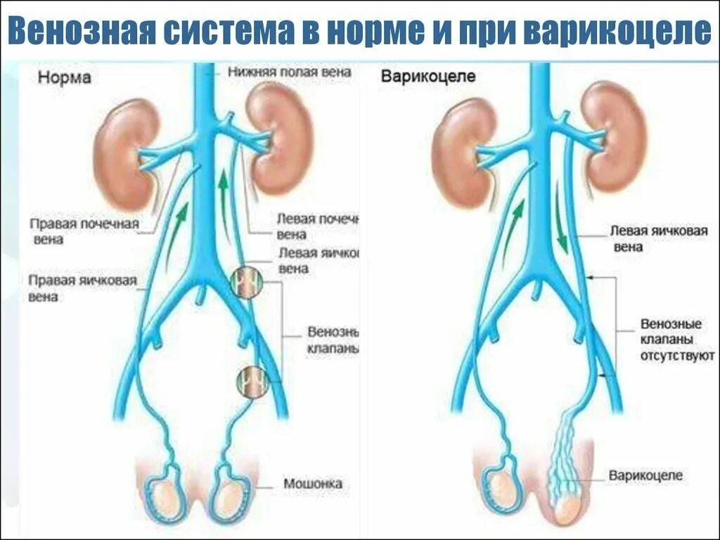 Почему яйца висят. Варикозное расширение вен семенного канатика. Варикоцеле — варикозное расширение вен яичка и семенного канатика.. Вены семенного канатика анатомия.