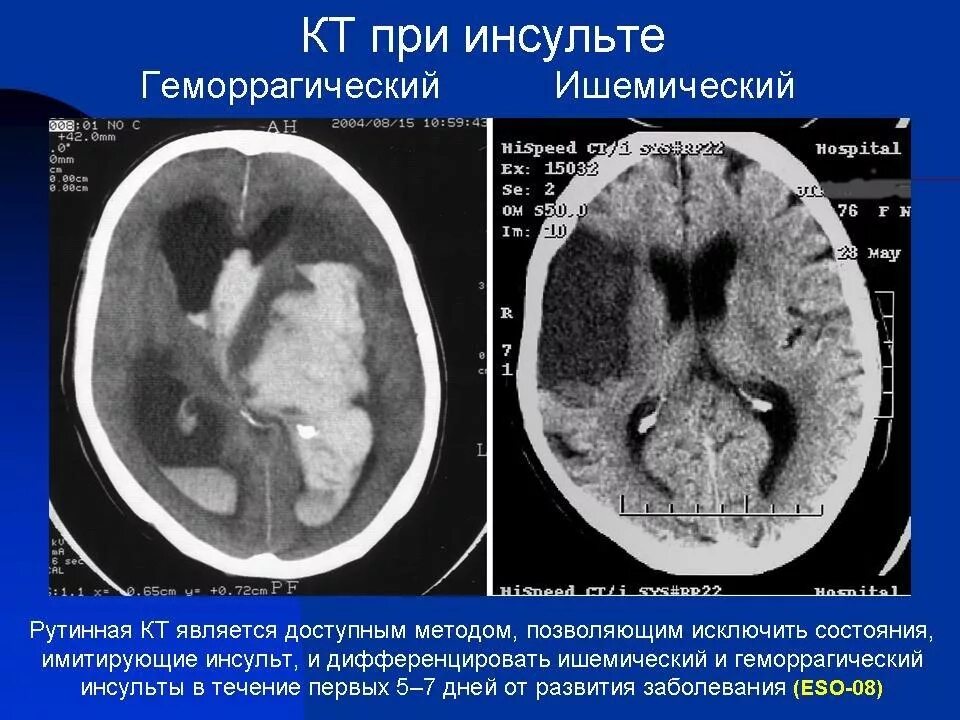 Очаг ишемического инсульта на кт. Кт и мрт при ишемическом и геморрагическом инсульте. Ишемический инсульт на кт головного мозга. Ишемический инсульт снимок кт.