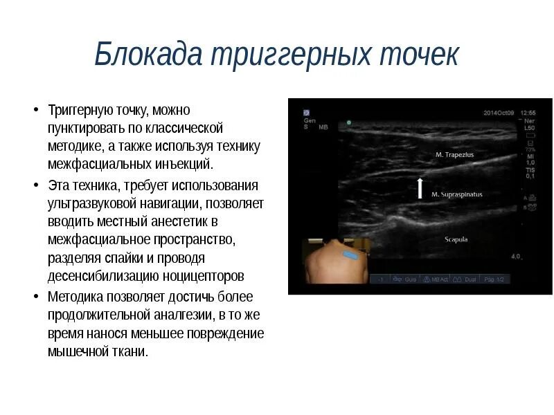 Блокада под узи. Это блокада нерва под УЗИ контролем. УЗИ навигация при блокаде. Блокада триггерных точек.