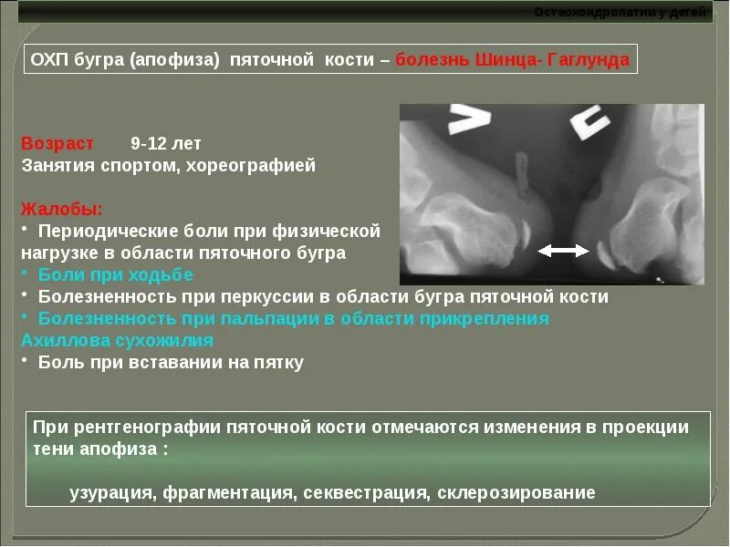 Болезнь шинца у детей код по мкб. Остеохондропатия апофиза бугра пяточной кости. остеохондропатия бугра пяточной кости рентген. фрагментация апофиза бугра пяточной кости. болезнь шинца на рентгенограмме.