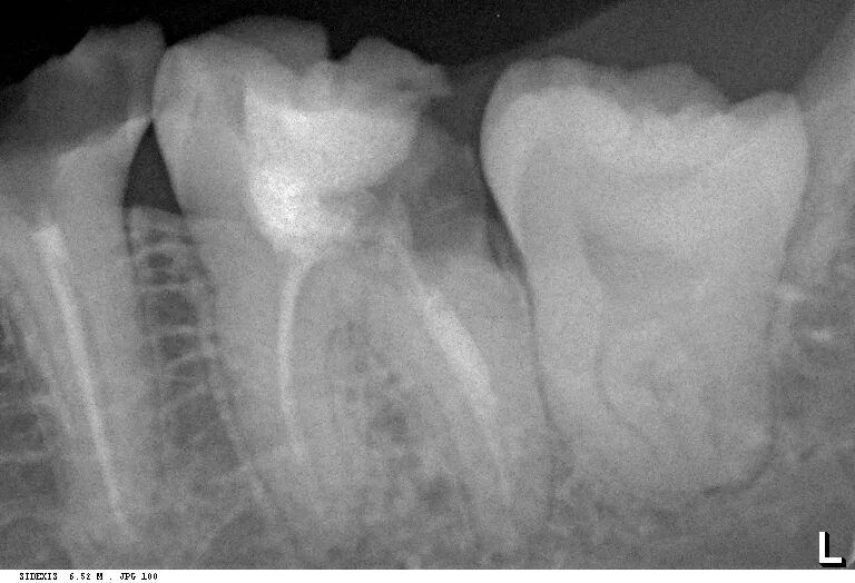 Зуб 8 нижний. Зуб мудрости рентген снимок.