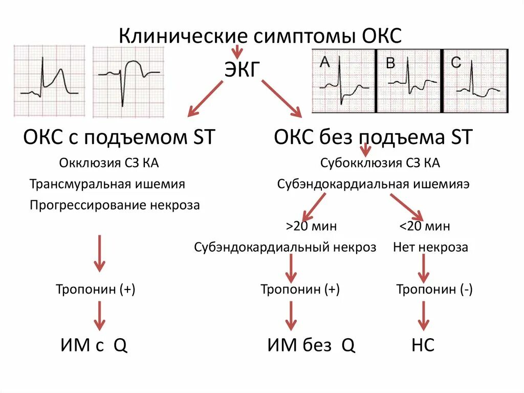 Субэндокардиальный инфаркт на ЭКГ. Субэндокардиальный инфаркт миокарда на ЭКГ. Субэндокардиальные изменения на ЭКГ. Субэндокардиальная ишемия на ЭКГ признаки.