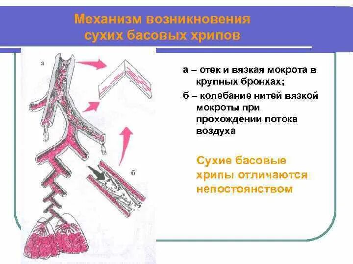 Как понять есть ли хрипы. Схема возникновения хрипов. механизм возникновения сухих хрипов. образование мокроты в бронхах. хрипы в бронхах бронхах.
