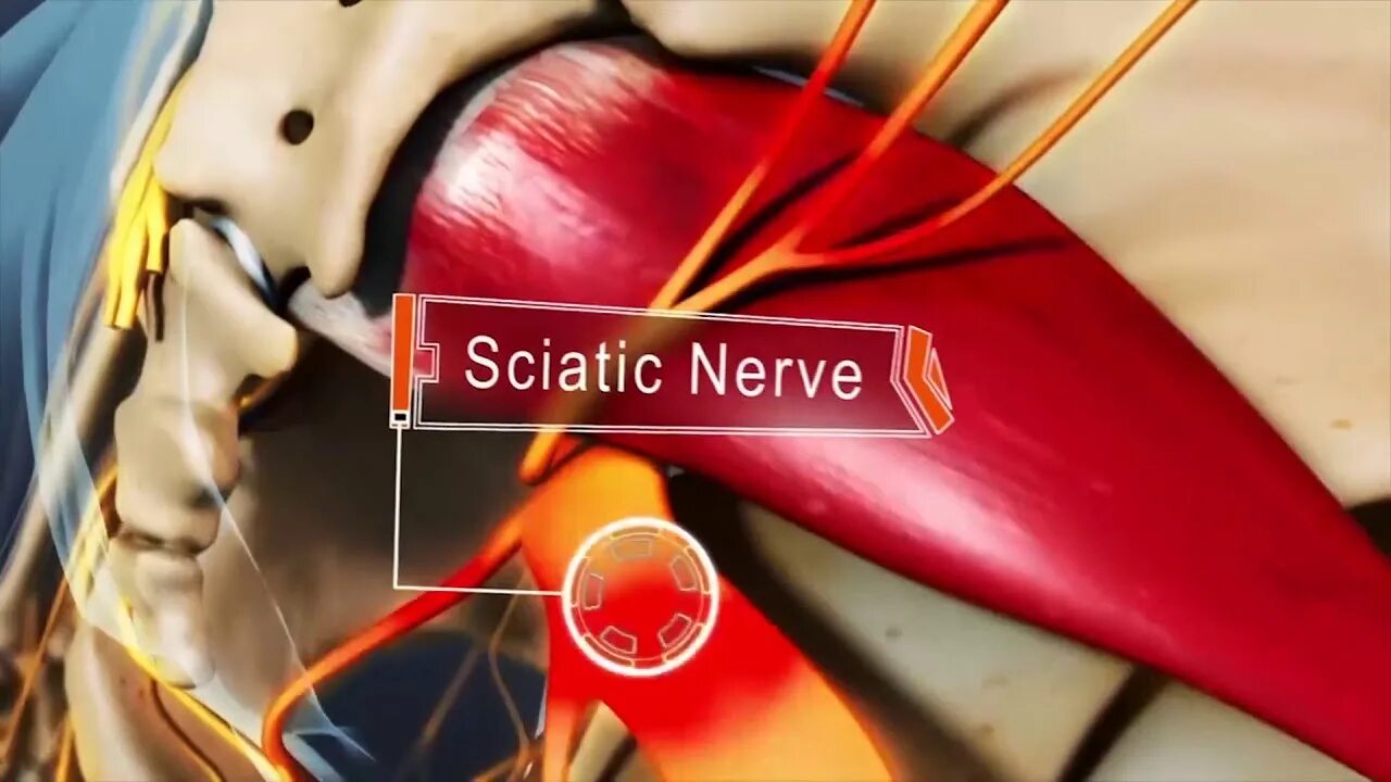 Нейропатия затылочного нерва. Седалищный нерв (sciatic nerve)? 011. Защемление седалищного нерва блокада. Защемление седалищного нерва грушевидной мышцей. Грушевидная мышца защемляет седалищный нерв.