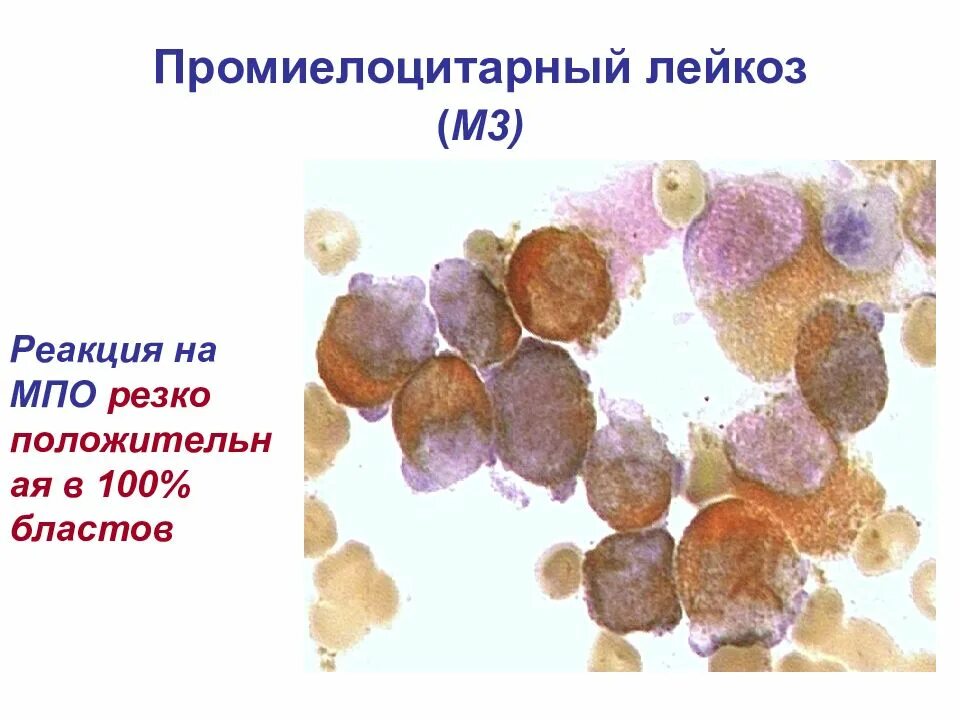 Острый промиелоцитарный лейкоз презентация. Острые промиелоцитарные лейкозы. Острый промиелоцитарный лейкоз м3. Резко положительная реакция