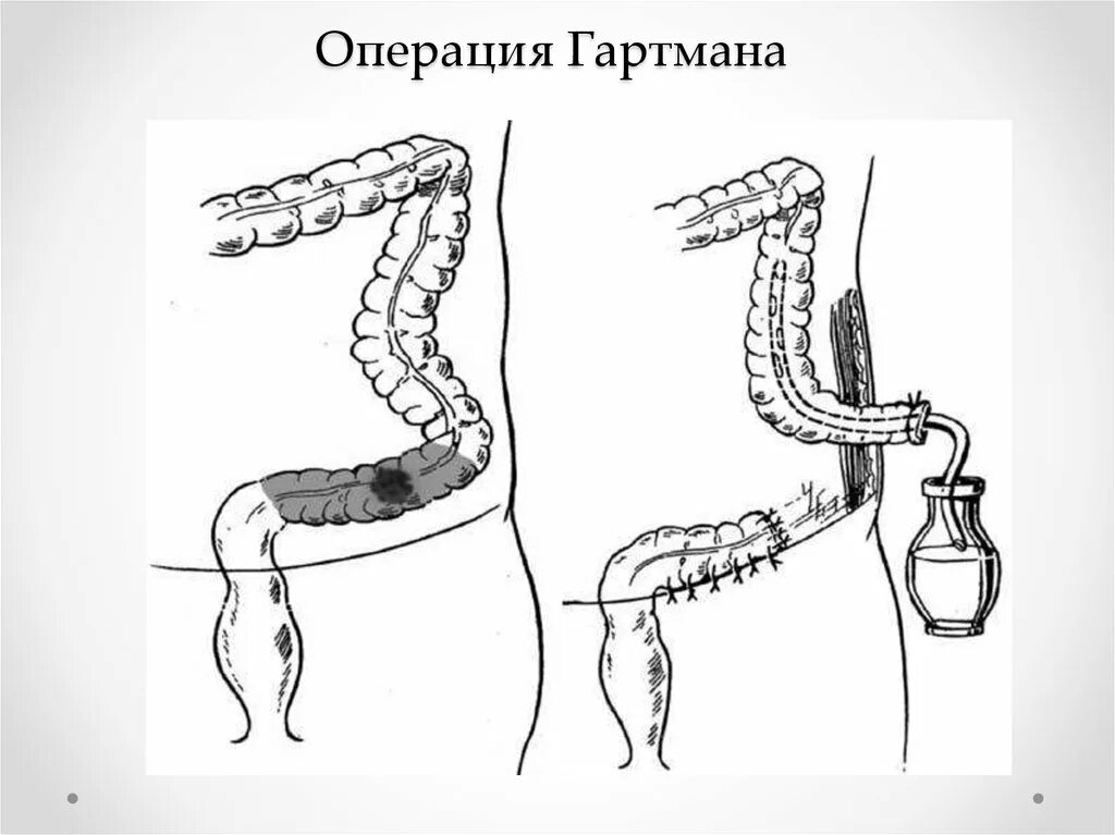 Операция толстой. Резекция толстой кишки по Гартману. Операция Гартмана на толстой кишке. Операция Гартмана на сигмовидной кишке. Колостома операция Гартмана.