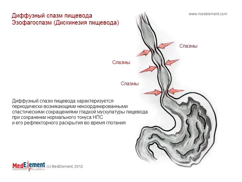 Пищевод пища время. Эзофагоспазм патогенез. Сегментарный спазм пищевода рентген. Эзофагоспазм пищевода. Диффузный спазм пищевода рентген.